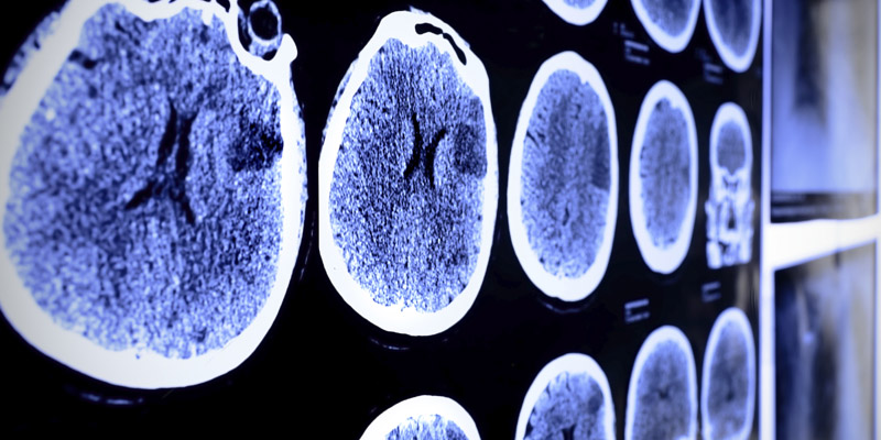 mainpic-brain-injury